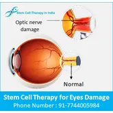 stem cell treatment for optic nerve atrophy India