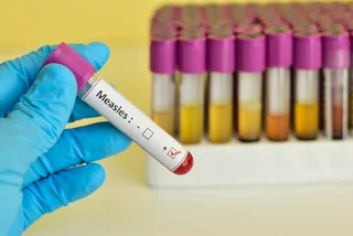 The Czech Republic loses its measles-free status, sees twice as many cases